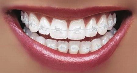 Ceramic Braces  How do they work and what's the advantage?