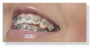 metal bracket braces
