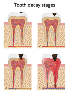 Throbbing Tooth Pain After Filling | Tooth Sensitivity