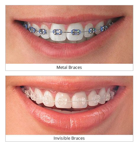 invisible braces with color