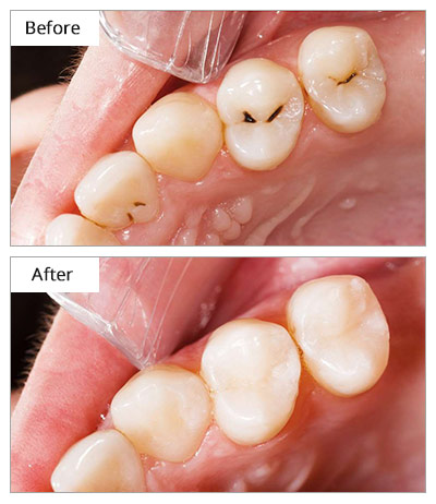 Porcelain Dental Filling  