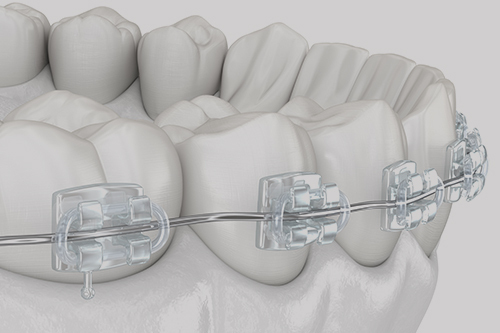 Common Clear Braces Maintenance and Aftercare - New York Dental
