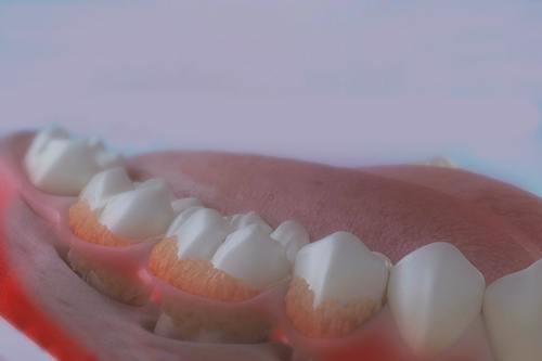 Scaling & Deep Cleaning - Periodontal Therapy - The Brooklyn Dentist