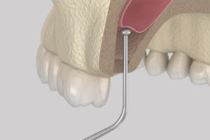 Sinus Lift Surgery, Sinus Augmentation · Broadway Family Dental