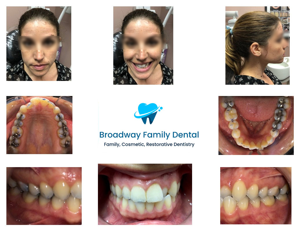Dental Braces in Brooklyn, NY - Broadway Family Dental