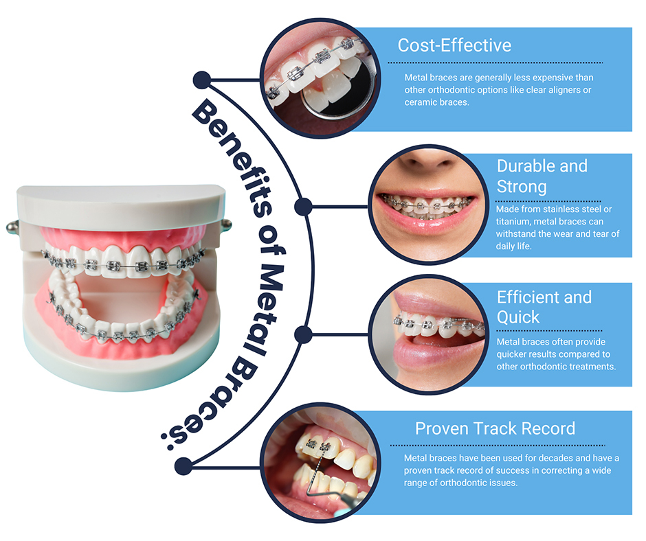 Advantages and disadvantages of ceramic braces – Somos Dental