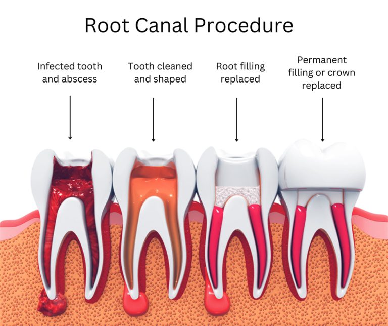 Root Canal Procedure Bushwick, Brooklyn, NY | Endodontics Therapy