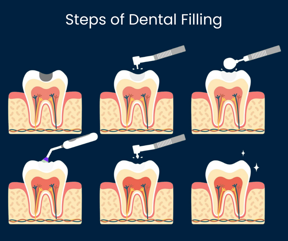 DENTAL FILLINGS improve the function of the jaw for biting and chewing