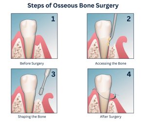 Osseous Surgery in Bushwick, Brooklyn, NY | Bone Surgery and Recovery ...