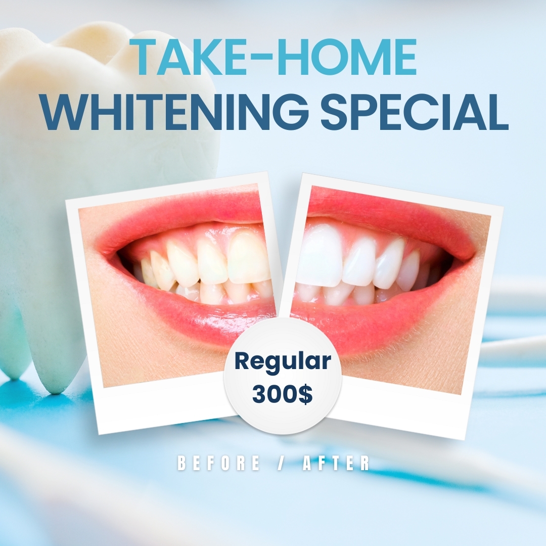 Take-Home Whitening Special Now Only 300$!