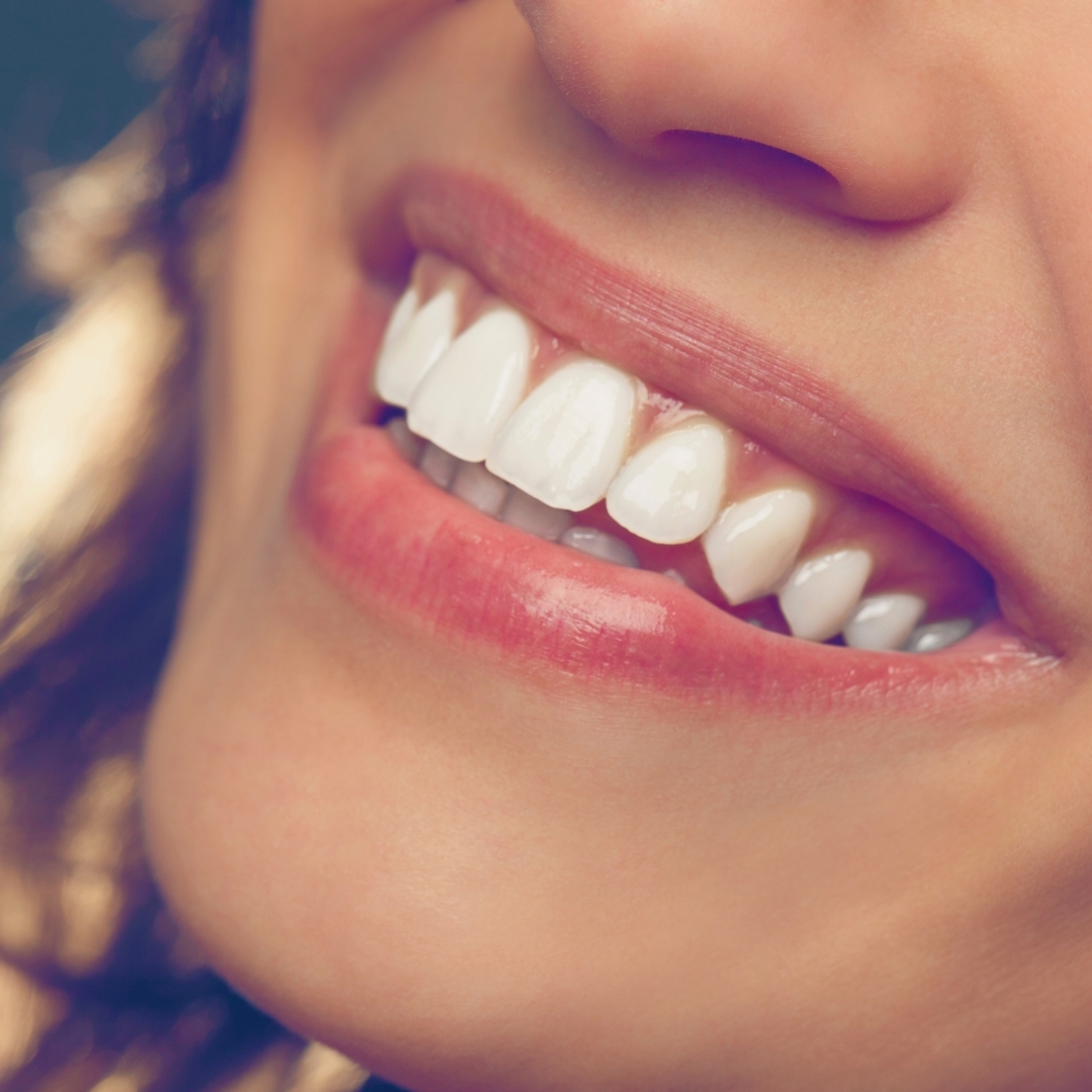 How Do Dental Veneers Work?