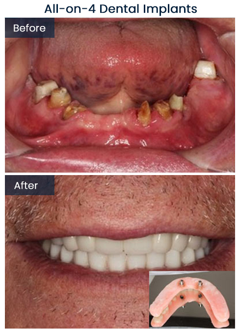 All-on-4 Dental Implants Bushwick Before and After