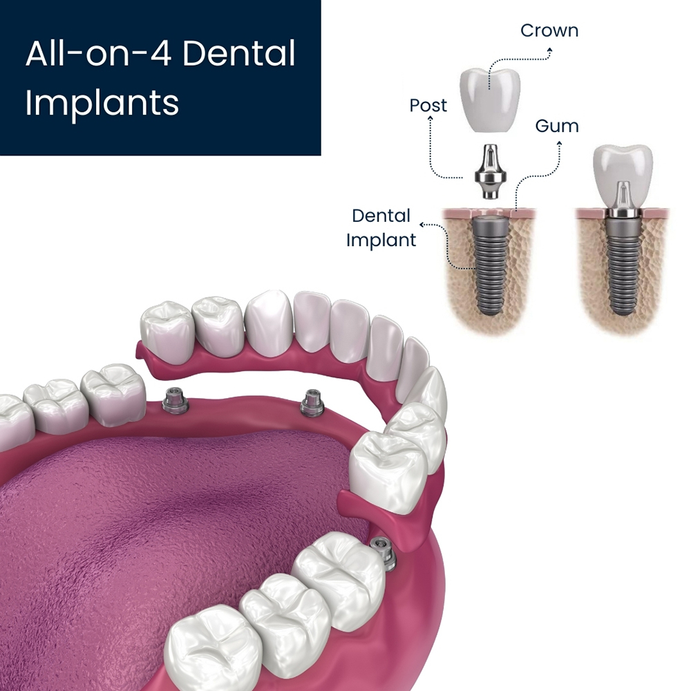 All-on-4 Dental Umplants Procedure