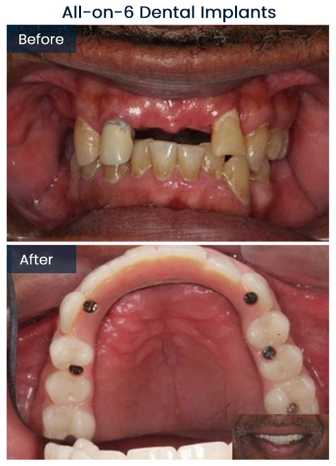 All-on-6 Dental Implants Bushwick Before and After