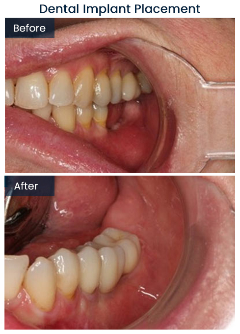 Dental Implant Placement Bushwick Before and After