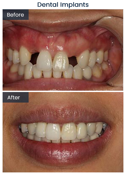 Dental Implants Bushwick Before and After