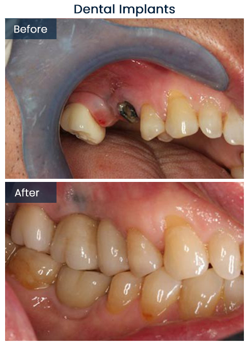 Dental Implants Bushwick Before and After