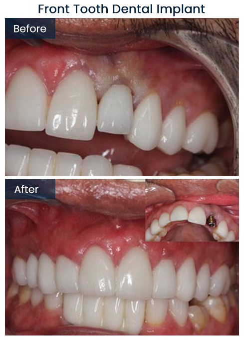 Front Tooth Implant Before and After