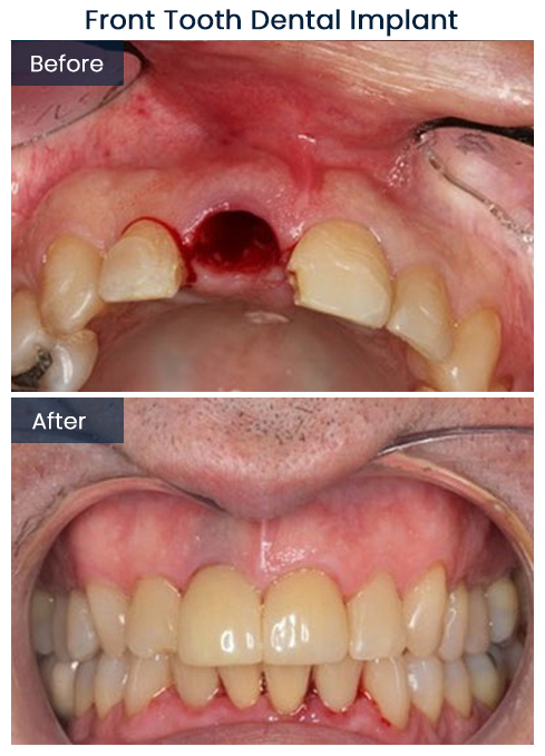 Front Tooth Implant Dentist Bushwick Before and After