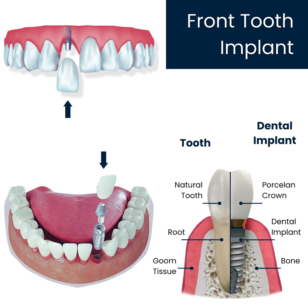 Front Tooth Implant