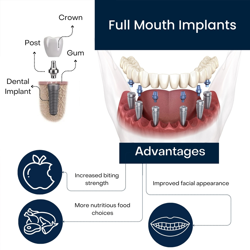 Full Mouth Implants in Bushwick