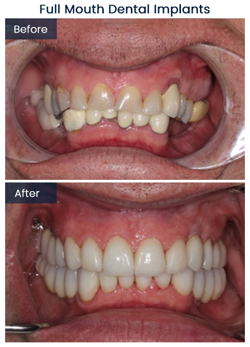 Full Mouth Rehab Multiple Dental Implants Before and After